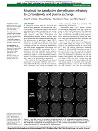 Rituximab for tumefactive demyelination refractory.pdf.jpg